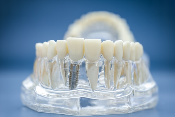 Proper Care For Dental Implants