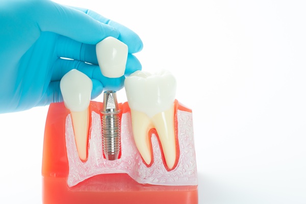 Consult An Implant Specialist To Enhance Your Smile