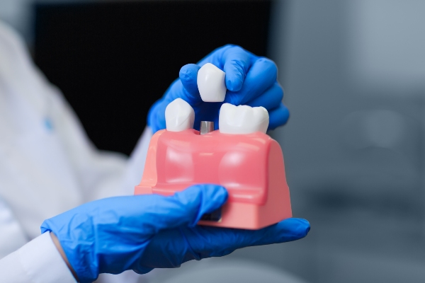 Preparing For A Dental Implants Procedure